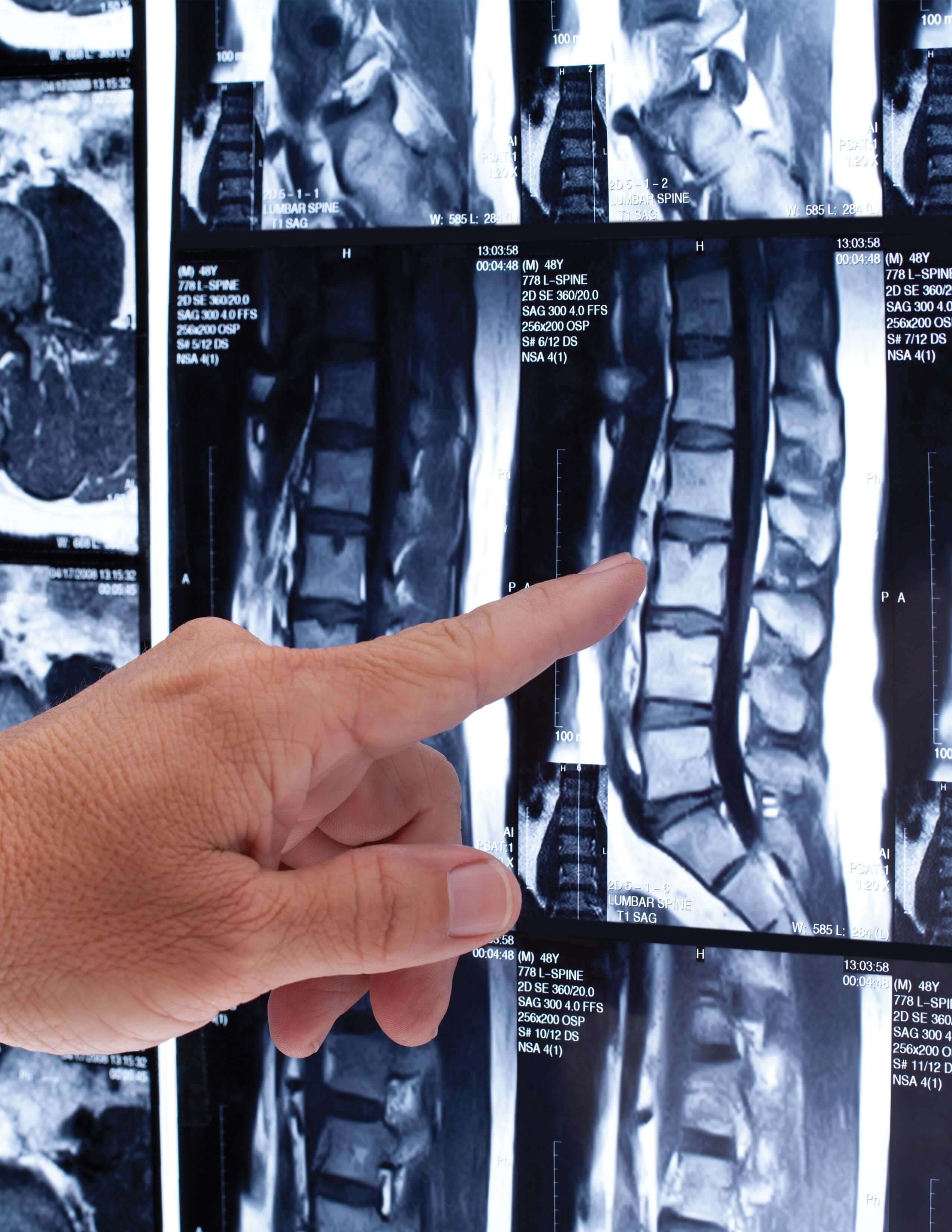 spine mri review at OrthoIndy